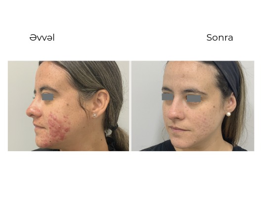 Candela Vbeam Perfecta